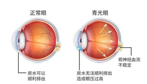 专家说眼病丨青光眼就是眼压高？