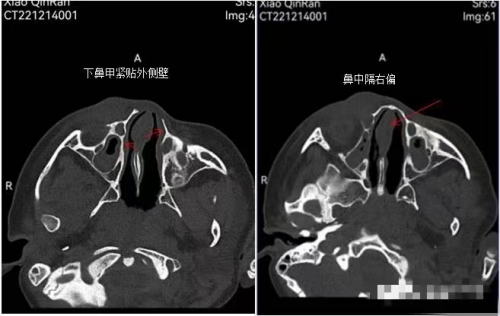 兰州爱尔眼科医院范好荣主任分享案例：拖延的新生儿泪囊炎