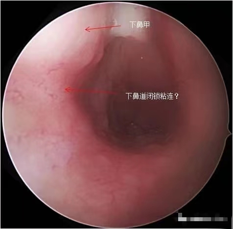 兰州爱尔眼科医院范好荣主任分享案例：拖延的新生儿泪囊炎