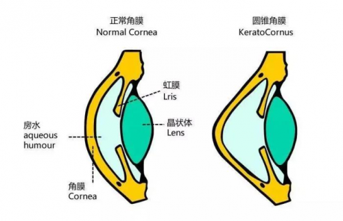 甘肃爱尔眼视光盛迅伦团队完成角膜基质透镜植入联合角膜胶原交联术