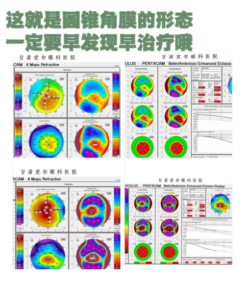 甘肃爱尔眼视光盛迅伦团队完成角膜基质透镜植入联合角膜胶原交联术