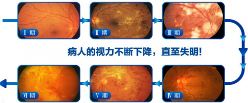 3.9【陈雪艺院长】“糖网”是个什么网？早期难发现晚期可致盲