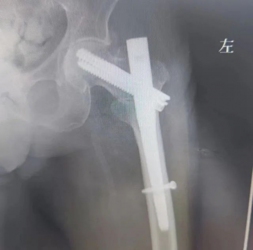 北京市健宫医院成功完成一例“左股骨转子间骨折闭合复位髓内钉内固定术”手术