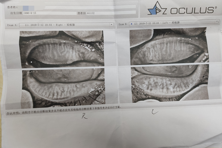 相关检查,鑫儿被确诊为由睑板腺泪膜水油分泌不平衡导致的混合型干眼