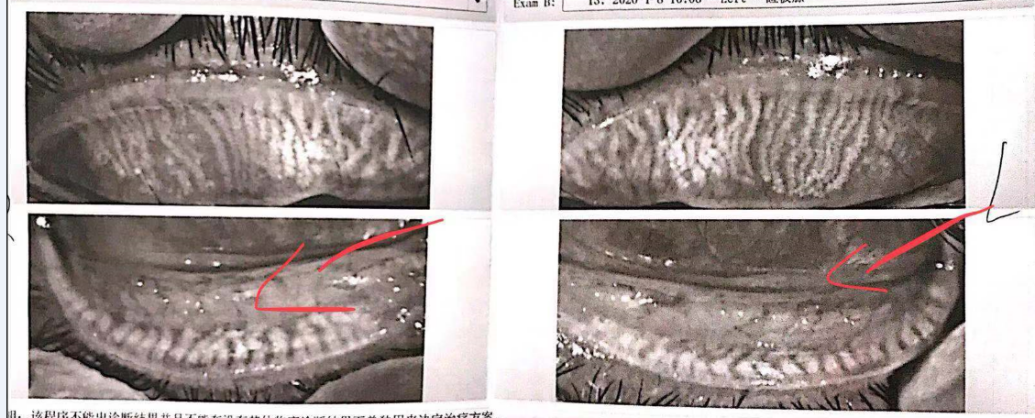 眼睛干燥、眼睛干痒、眼睛疲劳、眼睛除螨虫，看爱尔眼科专家如何治疗干眼症