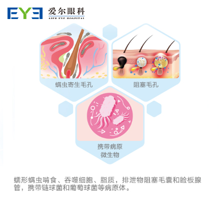 螨虫型干眼的成因