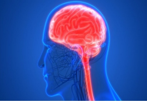 华志医疗无框架脑立体定向技术——脑干出血患者的福音