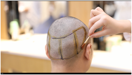 深圳植发市场火爆，雍禾医生建议治疗脱发要慎选机构