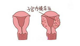 运动导致子宫内膜异位症该怎么办 运动导致子宫内膜异位症该怎么办