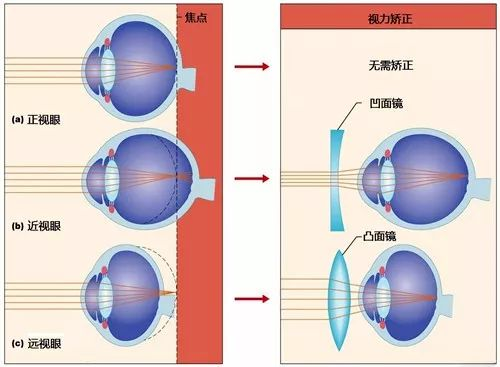 西宁爱尔眼科医院：案例分享丨近视手术不止治疗近视！