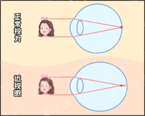 西宁爱尔眼科医院：案例分享丨近视手术不止治疗近视！