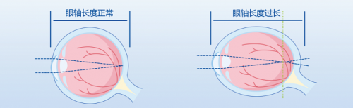 桂林爱尔眼科解答：孩子近视不到100度，要不要戴眼镜？