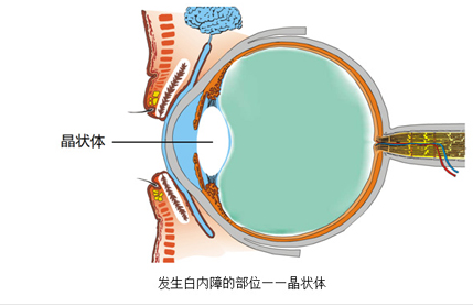 爱尔眼科专业白内障治疗技术，帮白内障患者重见光明