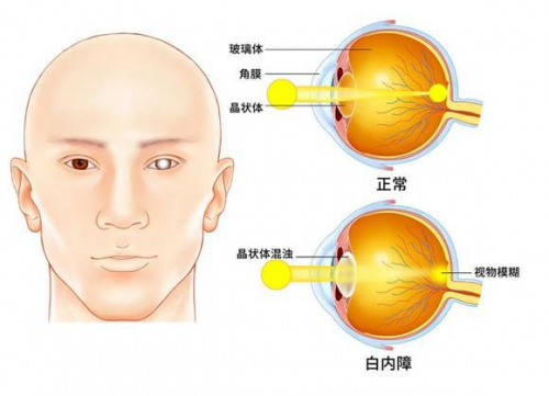 爱尔眼科专业白内障治疗技术，帮白内障患者重见光明