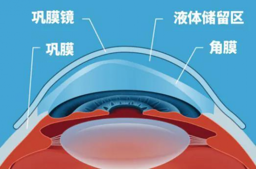 【新技术】光学矫正的终极解决方案—青海爱尔眼科医院成功验配首例巩膜镜